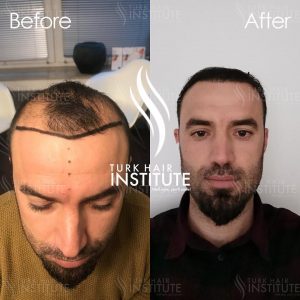 turk-hair-before-after-13